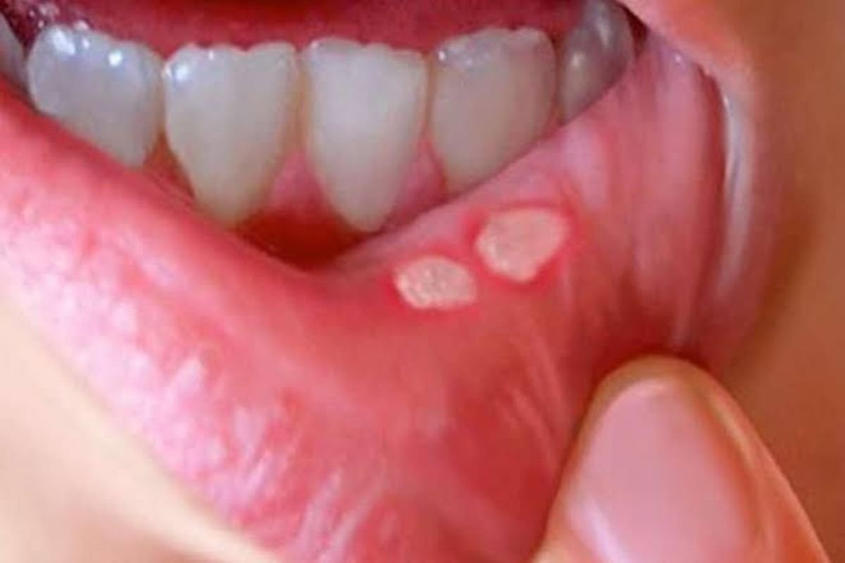 Sering Sariawan? Bisa Jadi Tanda Penyakit Autoimun